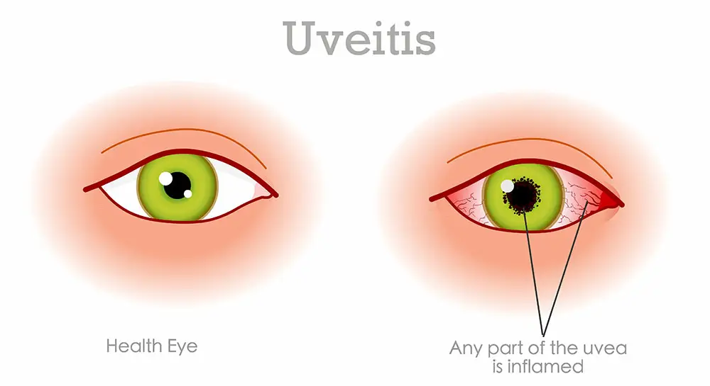 uveitis image 2